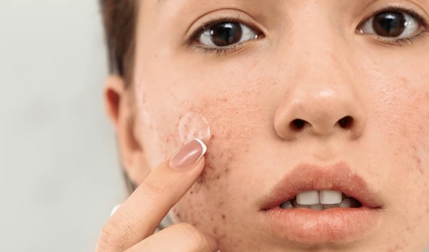 Can a Dairy Allergy Cause Acne?